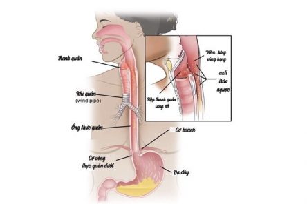 Trào ngược im lặng – Cách nào nhận biết và điều trị