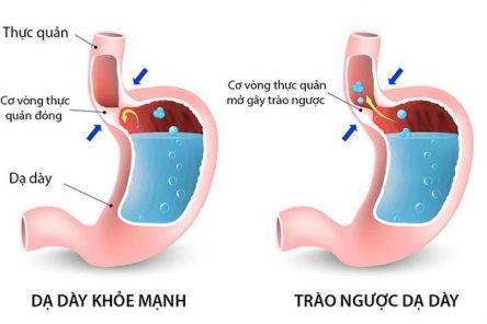 Trào ngược dạ dày mãn tính có chữa được không? Hướng dẫn 5 cách hiệu quả nhất