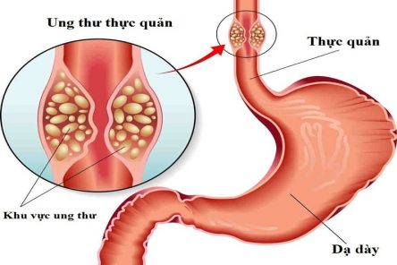 5 Biến chứng trào ngược dạ dày thực quản phổ biến nhất