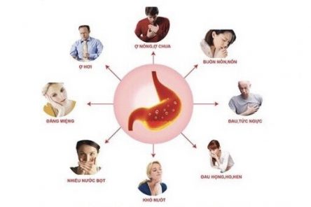 9 triệu chứng của bệnh trào ngược dạ dày thực quản theo thứ tự xuất hiện