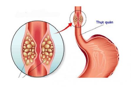 8 hậu quả khôn lường của trào ngược dạ dày