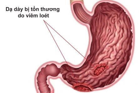 5 Nguyên nhân mắc trào ngược dạ dày thực quản phổ biến ai cũng có thể mắc phải